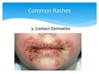 Common Rashes
3. Contact Dermatitis
 