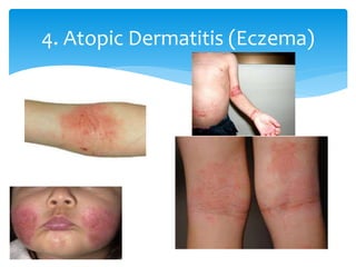 4. Atopic Dermatitis (Eczema)
 
