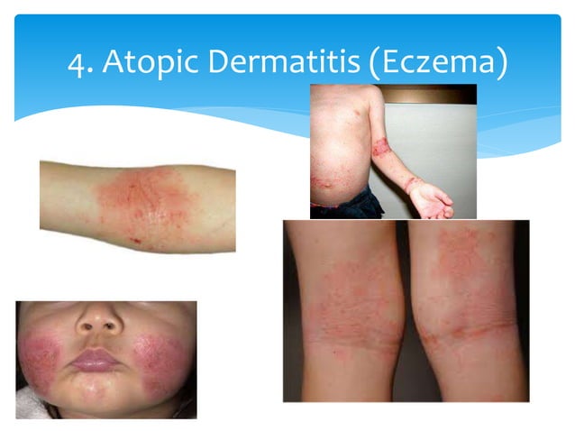 Paediatric rashes | PPTX | Infectious Diseases | Diseases and Conditions