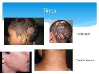 Tinea
Tineas Capitis
Tinea Versicolour
 