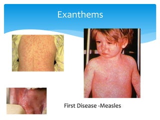 Exanthems
First Disease -Measles
 