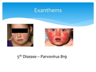 Exanthems
5th Disease – Parvovirus B19
 