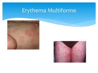 Erythema Multiforme
 