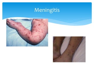 Meningitis
 