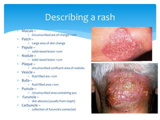  Macule –
 Circumscribed are of change <1cm
 Patch –
 Large area of skin change
 Papule –
 solid raised lesion <1cm
 Nodule –
 solid raised lesion >1cm
 Plaque –
 circumscribed confluent area of nodules
 Vesicle –
 fluid filled are <1cm
 Bulla –
 fluid filled area >1cm
 Pustule –
 circumscribed area containing pus
 Furuncle –
 skin abscess (usually from staph)
 Carbuncle –
 collection of furuncles connected
Describing a rash
 