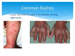  4 year old child brought in by parents. Itching
vigorously.
Common Rashes
 