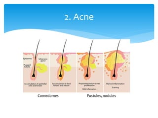 2. Acne
Comedomes Pustules, nodules
 