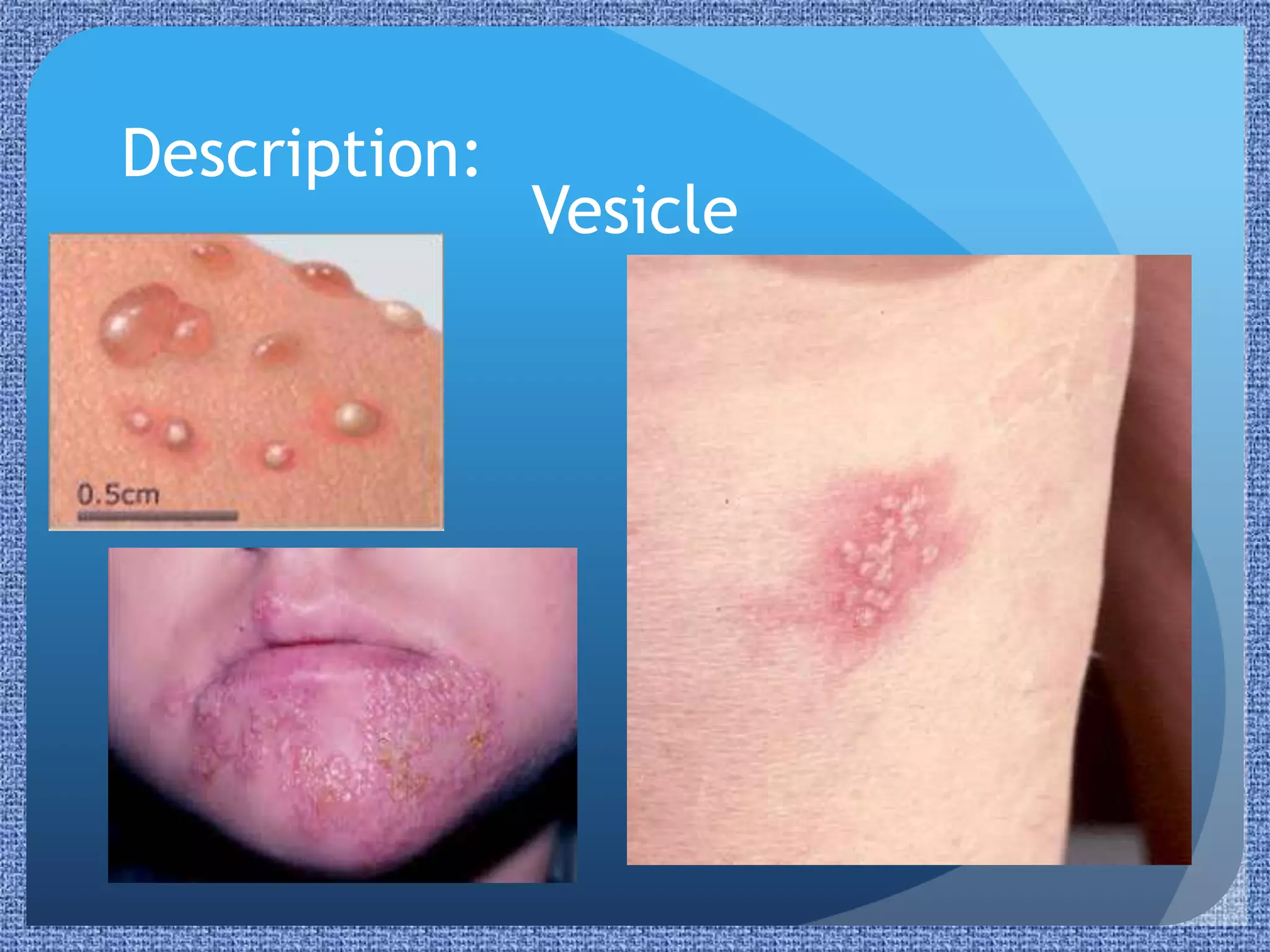 Vesicular Rash Infant Paediatric Rashes | PPTX