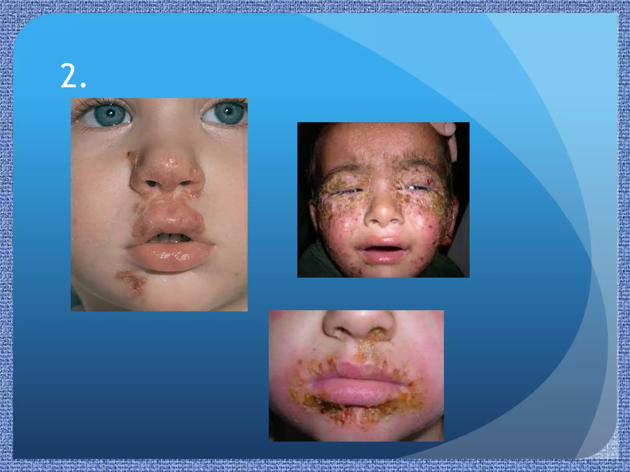 Paediatric Rashes | PPTX