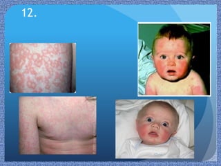 Infant Rash Directory Paediatric Rashes | PPTX
