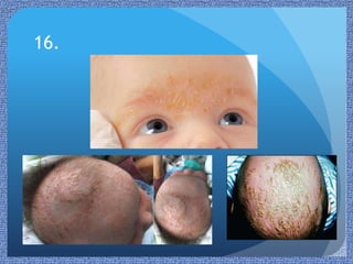 Paediatric Rashes | PPTX