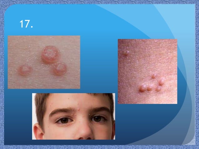 Paediatric Rashes | PPTX | Infectious Diseases | Diseases and Conditions