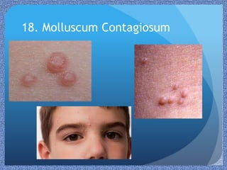 Paediatric Rashes | PPTX