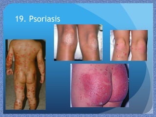 Pedia Rash Paediatric Rashes | PPTX