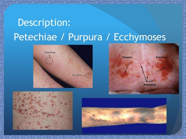 vasculitis images pictures photos christmas tree disease in humans