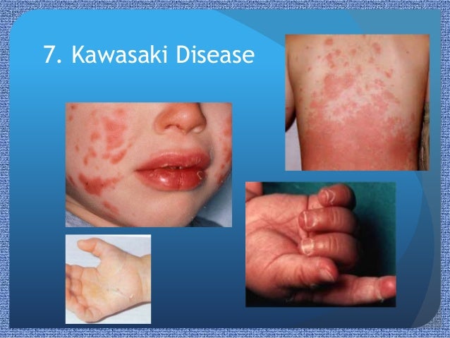 Paediatric Rashes