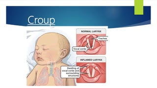 Croup
 