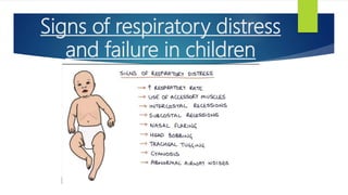 Signs of respiratory distress
and failure in children
 