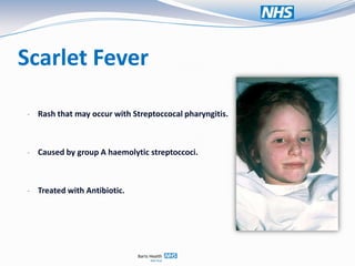 Scarlet Fever

- Rash that may occur with Streptoccocal pharyngitis.



- Caused by group A haemolytic streptoccoci.



- Treated with Antibiotic.
 