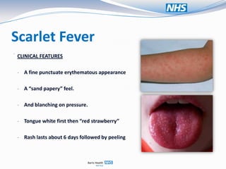 Scarlet Fever
.
    CLINICAL FEATURES

    - A fine punctuate erythematous appearance


    - A “sand papery” feel.


    - And blanching on pressure.


    - Tongue white first then “red strawberry”


    - Rash lasts about 6 days followed by peeling
 