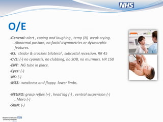 O/E
-General: alert , cooing and laughing , temp (N) weak crying.
   Abnormal posture, no facial asymmetries or dysmorphic
   features.
-RS: stridor & crackles bilateral , subcostal recession, RR 45
-CVS: (-) no cyanosis, no clubbing, no SOB, no murmurs. HR 150
-ENT: NG tube in place.
-Eyes: (-)
-NS: (-)
-MSS: weakness and floppy lower limbs.

-NEURO: grasp reflex (+) , head lag (-) , ventral suspension (-)
   , Moro (-)
-SKIN: (-)
 