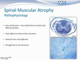 Spinal Muscular Atrophy
 Pathophysiology

 Loss of this gene – loss of function in proteins for
  RNA processing

 Toxic effect on lower motor neurones


 Anterior horn cells affected


 CN affected V, VII, IX and XII
 