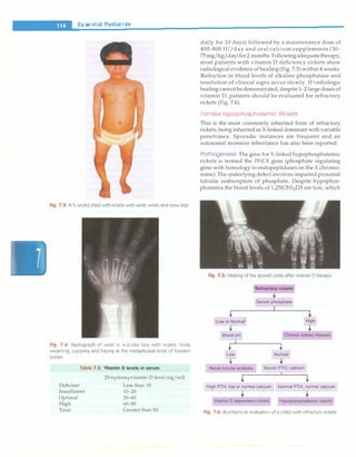 __
e_s_s_e_n_ti_a
_1_P_e_d_1a_t_ri
_cs-------------------------------
Fig. 7.3: A 5-yr-
old child with rickets with wide wrists and bow legs
Fig. 7.4: Radiograph of wrist in 4-yr-old boy with rickets. Note
widening, cupping and fraying at the metaphyseal ends of forearm
bones
Table 7.2: Vitamin D levels in serum
Deficient
Insufficient
Optimal
High
Toxic
25-hydroxyvitamin D level (ng/ml)
Less than 10
10-20
20-60
60-90
Greater than90
daily for 10 days) followed by a maintenance dose of
400-800 IU/day and oral calcium supplements (30-
75mg/kg/day)for2 months. Followingadequatetherapy,
most patients with vitamin D deficiency rickets show
radiological evidence of healing (Fig. 7.5)within 4 weeks.
Reduction in blood levels of alkaline phosphatase and
resolution of clinical signs occur slowly. If radiologic
healing cannotbedemonstrated, despite 1 -
2large dosesof
vitamin D, patients should be evaluated for refractory
rickets (Fig. 7.6).
Familial Hypophosphatemic Rickets
This is the most commonly inherited form of refractory
rickets, being inheritedas X-linked dominantwithvariable
penetrance. Sporadic instances are frequent and an
autosomal recessive inheritance has also been reported.
Pathogenesis The gene for X-linked hypophosphatemic
rickets is termed the PHEX gene (phosphate regulating
gene with homology to endopeptidases on the X chromo­
some). Theunderlying defect involves impairedproximal
tubular reabsorption of phosphate. Despite hypophos­
phatemia the blood levels of 1,25(0H)z03 are low, which
Fig. 7,5: Healing of the growth plate after vitamin D therapy
Refractory rickets
Serum phosphate]
I
+
Low or Normal High
+
Blood pH]
I
Chronic kidney disease
Lowl Normal
...
Renal tubular acidosis Serum PTH, calcium
i i
High PTH, low or normal calcium] Normal PTH, normal calcium
+ +
Vitamin D dependent rickets Hypophosphatemic rickets
Fig. 7.6: Biochemical evaluation of a child with refractory rickets
 