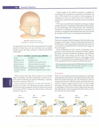 . __E_s_s_e_n_ t_ia_l_P_e_d_i_a _tr_ic_s_________________________________
Fig. 8.6: Properly fitting mask
(Adapted with permission from AAP 2005)
an appropriate rise of the chest and auscultate for breath
sounds. If chest does not rise and there are no audible
breath sounds, the steps outlines in Table 8.3 should be
undertaken.
Table 8.3: Ventilation corrective steps (MRSOPA)
Action
Inadequate seal
Blocked airway
Blocked airway
Blocked airway
Inadequate pressure
Consider alternate
airway
Condition
Re apply mask
Reposition the infant's head
Clear secretions by suction
Ventilate with mouth slightly open
Increase pressure slightly
Blocked airway(endotracheal tube)
When normal rise of the chest is observed, one should
begin ventilating. Ventilation should be carried out at a
rate of 40 to 60 breaths per minute, following a 'squeeze,
two, three' sequence (Fig. 8.7).
Usual pressure required for the first breath is
30-40 cm of water. For subsequent breaths, pressure of
15-20 cm of water is adequate. After the infant has received
30 seconds of PPV, evaluate the HR and take a followup
action as in Fig. 8.2.
One
(Squeeze)
Two Three
(Release ......
)
Improvement in the infant's condition is judged by
increasing HR, spontaneous respiration and improving
color. If the infant fails to improve, check adequacy of
ventilation in form of visible chest rise. If chest rise is
inadequate, one should take necessary action as described
earlier.
PPV may cause abdominal distension as the gas escapes
into the stomach viaesophagus.Distended stomachpresses
on the diaphragm and compromises the ventilation.
Therefore, if ventilation is continued for more than two
minutes,an orogastric tube (feeding tube size 6-8Fr) should
be inserted and left open to decompress the abdomen.
Chest Compressions
The heart circulates blood throughout the body delivering
oxygen to vital organs. When an infant becomes hypoxic,
the HR slows and myocardial contractility decreases. As
a result there is diminished flow of blood and oxygen to
the vital organs.
Chest compressions (CC) consist of rhythmic com­
pression of the sternum that compress the heart against
the spine, increase intrathoracic pressure and circulate
blood to the vital organs of the body. CC help in
mechanically pumping the blood to vital organs of the
body. CC must always be accompanied by BMV so that
only oxygenated blood is being circulated during CC.
Chest compressionsareindicatedif HR is below60/mineven
after 30 seconds of PPV. Once the HR is 60/min or more,
chest compressions should be discontinued.
Procedure
There are twotechniquesfor chest compressions: (i) thumb
technique (Fig. 8.8), and (ii) two-finger technique (Fig. 8.9).
With the thumb technique, the two thumbs are used to
depress the sternum, with the hands encircling the torso
and the fingers supporting the back. In two-finger
technique, the tips of the middle finger and either index
or ring finger of one hand is used to depress the sternum.
The other hand is used to support the infant's back, unless
the infant is on a firm surface.
One
(Squeeze)
Two Three
(Release ......)
Fig. 8.7: Correct rhythm of providing positive pressure ventilation.(Adapted with permission from American Academy of Pediatrics 2005)
 