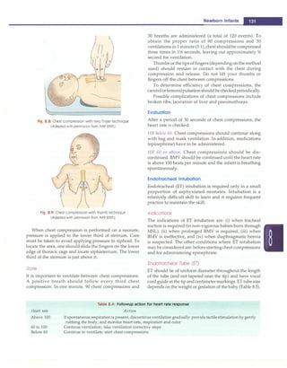 Fig. 8.8: Chest compression with two finger technique
(Adapted with permission from AAP 2005)
Fig. 8.9: Chest compression with thumb technique
(Adapted with permission from AAP 2005)
When chest compression is performed on a neonate,
pressure is applied to the lower third of sternum. Care
must be taken to avoid applying pressure to xiphoid. To
locate the area, one should slide the fingers on the lower
edge of thoracic cage and locate xiphisternum. The lower
third of the sternum is just above it.
Rate
It is important to ventilate between chest compressions.
A positive breath should follow every third chest
compression. In one minute, 90 chest compressions and
Newborn Infants -
30 breaths are administered (a total of 120 events). To
obtain the proper ratio of 90 compressions and 30
ventilations in1minute(3:1),chestshouldbe compressed
three times in 1h seconds, leaving out approximately h
second for ventilation.
Thumbs orthe tipsoffingers (dependingonthe method
used) should remain in contact with the chest during
compression and release. Do not lift your thumbs or
fingers off the chest between compressions.
To determine efficiency of chest compressions, the
carotidorfemoralpulsationshouldbecheckedperiodically.
Possible complications of chest compressions include
broken ribs, laceration of liver and pneumothorax.
Evaluation
After a period of 30 seconds of chest compressions, the
heart rate is checked:
HR below 60. Chest compressions should continue along
with bag and mask ventilation. In addition, medications
(epinephrine) have to be administered.
HR 60 or above. Chest compressions should be dis­
continued. BMV should be continued until the heart rate
is above 100 beats per minute and the infant is breathing
spontaneously.
Endotracheal Intubation
Endotracheal (ET) intubation is required only in a small
proportion of asphyxiated neonates. Intubation is a
relatively difficult skill to learn and it requires frequent
practice to maintain the skill.
Indications
The indications of ET intubation are: (i) when tracheal
suction is required (in non-vigorous babies born through
MSL), (ii) when prolonged BMV is required, (iii) when
BMV is ineffective, and (iv) when diaphragmatic hernia
is suspected. The other conditions where ET intubation
may be considered are: beforestartingchest compressions
and for administering epinephrine.
Endotracheal Tube (ET)
ET should be of uniform diameter throughout the length
of the tube (and not tapered near the tip) and have vocal
cord guide at the tip andcentimetermarkings. ETtube size
depends on the weight or gestation of the baby (Table 8.5).
Heart rate
Above 100
Table 8.4: Followup action for heart rate response
Action
60 to 100
Below 60
Ifspontaneousrespirationispresent, discontinue ventilation gradually: provide tactile stimulation by gently
rubbing the body, and monitor heart rate, respiration and color
Continue ventilation; take ventilation corrective steps
Continue to ventilate; start chest compressions
 