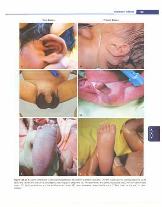 Newborn Infants -
Term Babies Preterm Babies
Figs 8,1 SA to F: Salient difference in physical characteristics of preterm and term neonates: (A) Well-curved pinna, cartilage reaching up to
periphery; (B) flat and soft pinna, cartilage not reaching up to periphery; (C) well pigmented and pendulous scrotal sacs, with fully descended
testes; (D) light pigmentation and not yet descended testes; (E) deep transverse creases on the soles; (F) faint marks on the sole, no deep
creases
 