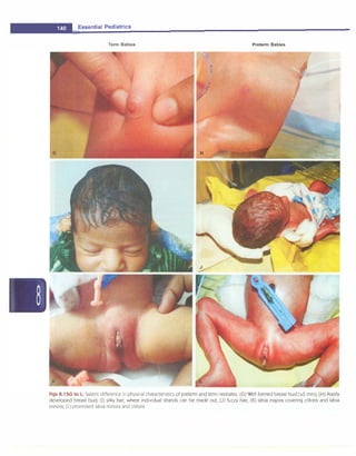 __E
_
s
_
s
_
e
_
n
_
t
_
ia
_
i
_
P
_
e
_
d
_
i
_
at
_
r
_
ic
_
s
________________________________
_
Term Babies Preterm Babies
Figs 8.1 SG to L: Salient difference in physical characteristics of preterm and term neonates: CG) Well formed breast bud C>S mm); CH) Poorly
developed breast bud; Cl) silky hair, where individual strands can be made out; (J) fuzzy hair; CK) labia majora covering clitoris and labia
minora; CL) prominent labia minora and clitoris
 