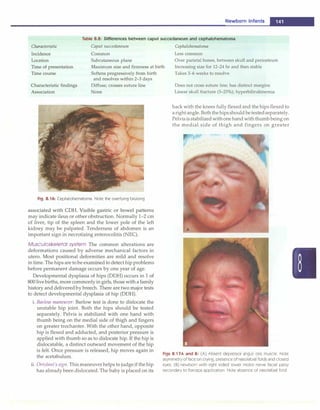 Newborn Infants -
Table 8.8: Differences between caput succedaneum and cephalohematoma
Characteristic
Incidence
Location
Caput succedaneum Cephalohematoma
Common
Subcutaneous plane
Less common
Time of presentation
Time course
Maximum size and firmness at birth
Softens progressively from birth
Over parietal bones, between skull and periosteum
Increasing size for 12-24 hr and then stable
Takes 3----6 weeks to resolve
Characteristic findings
Association
and resolves within 2-3 days
Diffuse; crosses suture line
None
Fig. 8.16: Cephalohematoma. Note the overlying bruising
associated with CDH. Visible gastric or bowel patterns
may indicate ileus or other obstruction. Normally 1-2 cm
of liver, tip of the spleen and the lower pole of the left
kidney may be palpated. Tenderness of abdomen is an
important sign in necrotizing enterocolitis (NEC).
Musculoskeletal system The common alterations are
deformations caused by adverse mechanical factors in
utero. Most positional deformities are mild and resolve
in time. The hips are tobe examined to detect hip problems
before permanent damage occurs by one year of age.
Developmental dysplasia of hips (DOH) occurs in 1 of
800 livebirths, more commonlyin girls, those with a family
history and deliveredby breech. There are two major tests
to detect developmental dysplasia of hip (DOH).
i. Barlow maneuver: Barlow test is done to dislocate the
unstable hip joint. Both the hips should be tested
separately. Pelvis is stabilized with one hand with
thumb being on the medial side of thigh and fingers
on greater trochanter. With the other hand, opposite
hip is flexed and adducted, and posterior pressure is
applied with thumb so as to dislocate hip. If the hip is
dislocatable, a distinct outward movement of the hip
is felt. Once pressure is released, hip moves again in
the acetabulurn.
ii. OrtoZani's sign. This maneuver helps to judgeif the hip
has already been dislocated. The baby is placed on its
Does not cross suture line; has distinct margins
Linear skull fracture (5-25%); hyperbilirubinernia
back with the knees fully flexed and the hips flexed to
arightangle. Boththehipsshouldbetestedseparately.
Pelvisisstabilizedwithone hand withthumbbeing on
the medial side of thigh and fingers on greater
Figs 8.17A and B: (A) Absent depressor anguli oris muscle. Note
asymmetry of face on crying, presence of nasolabial folds and closed
eyes. (B) newborn with right sided lower motor nerve facial palsy
secondary to forceps application. Note absence of nasolabial fold
 