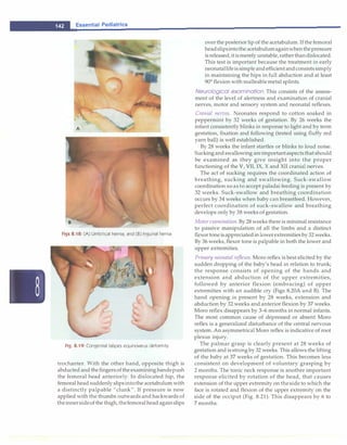 __
E_s_s_e_n_ti_a _i _P_e_d_ia_t_ri_cs--------------------------------
Figs 8.18: (A) Umbilical hernia; and (B) Inguinal hernia
Fig. 8.19: Congenital talipes equinovarus deformity
trochanter. With the other hand, opposite thigh is
abductedand thefingersoftheexamininghandspush
the femoral head anteriorly. In dislocated hip, the
femoral head suddenly slipsintothe acetabulum with
a distinctly palpable "clunk". If pressure is now
applied with the thumbs outwards and backwards of
theinnersideof the thigh,thefemoral headagainslips
overthe posteriorlip of the acetabulum. Ifthefemoral
headslipsintotheacetabulumagainwhenthepressure
isreleased, itismerelyunstable,ratherthandislocated.
This test is important because the treatment in early
neonatallifeissimpleandefficientandconsistssimply
in maintaining the hips in full abduction and at least
90°
flexion with malleablemetal splints.
Neurological examination This consists of the assess­
ment of the level of alertness and examination of cranial
nerves, motor and sensory system and neonatal reflexes.
Cranial nerves. Neonates respond to cotton soaked in
peppermint by 32 weeks of gestation. By 26 weeks the
infant consistently blinks in response to light and by term
gestation, fixation and following (tested using fluffy red
yarn ball) is well established.
By 28 weeks the infant startles or blinks to loud noise.
Suckingandswallowing areimportantaspectsthatshould
be examined as they give insight into the proper
functioning of the V, VII, IX, X and XII cranial nerves.
The act of sucking requires the coordinated action of
breathing, sucking and swallowing. Suck-swallow
coordination so as to accept paladai feeding is present by
32 weeks. Suck-swallow and breathing coordination
occurs by 34 weeks when baby can breastfeed. However,
perfect coordination of suck-swallow and breathing
develops only by 38 weeks of gestation.
Motor examination. By28 weeks there is minimal resistance
to passive manipulation of all the limbs and a distinct
flexortoneisappreciatedin lowerextremities by 32 weeks.
By 36 weeks, flexor tone is palpable in both the lower and
upper extremities.
Primary neonatal reflexes. Moro reflex is best elicited by the
sudden dropping of the baby's head in relation to trunk;
the response consists of opening of the hands and
extension and abduction of the upper extremities,
followed by anterior flexion (embracing) of upper
extremities with an audible cry (Figs 8.20A and B). The
hand opening is present by 28 weeks, extension and
abduction by 32 weeks and anterior flexion by 37weeks.
Moro reflex disappears by 3-6 months in normal infants.
The most common cause of depressed or absent Moro
reflex is a generalized disturbance of the central nervous
system. An asymmetrical Moro reflex is indicative of root
plexus injury.
The palmar grasp is clearly present at 28 weeks of
gestation and is strong by 32 weeks. This allows the lifting
of the baby at 37 weeks of gestation. This becomes less
consistent on development of voluntary grasping by
2 months. The tonic neck response is another important
response elicited by rotation of the head, that causes
extension of the upper extremity on theside to which the
face is rotated and flexion of the upper extremity on the
side of the occiput (Fig. 8.21). This disappears by 6 to
7months.
 
