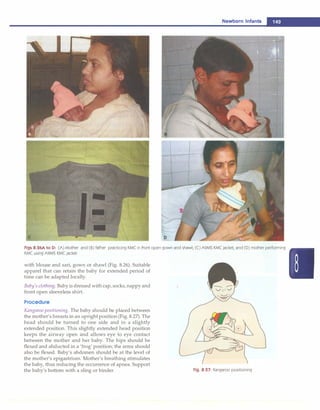 ------------------------------------N_e_w_b_o_r_n_i_n_ta_ n
_t_s_
....
D
J
I
Figs 8.26A to D: (A) Mother and (B) father practicing KMC in front open gown and shawl; (C) AIIMS KMC jacket; and (D) mother performing
KMC using AIIMS KMC jacket
with blouse and sari, gown or shawl (Fig. 8.26). Suitable
apparel that can retain the baby for extended period of
time can be adapted locally.
Baby's clothing. Baby is dressed with cap, socks, nappy and
front open sleeveless shirt.
Procedure
Kangaroo positioning. The baby should be placed between
the mother's breasts in an upright position (Fig. 8.27). The
head should be turned to one side and in a slightly
extended position. This slightly extended head position
keeps the airway open and allows eye to eye contact
between the mother and her baby. The hips should be
flexed and abducted in a 'frog' position; the arms should
also be flexed. Baby's abdomen should be at the level of
the mother's epigastrium. Mother's breathing stimulates
the baby, thus reducing the occurrence of apnea. Support
the baby's bottom with a sling or binder. Fig. 8.27: Kangaroo positioning
 
