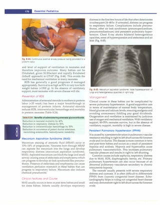 -
L..:
E
::
s
::
s
;:
e
:.:,
nt
:;,;
la
:,:
l
,.:
P
.,:
e
:,:
d
:.;,;
la
;;.:
t
�
rl
:
cs
:....____________________________
Fig. 8.44: Continuous positive airway pressure being provided to a
preterm baby
and level of support of ventilation in neonates and
therefore improves outcome. Many babies can be
INtubated, given SURfactant and rapidly Extubated
(lnSurE approach) to CPAP (Fig. 8.44). This avoids the
need for mechanical ventilation in many neonates.
RDS has generally a good prognosis if managed
appropriately. Survival is as high as 90% in verylowbirth
weight babies (<1500 g). In the absence of ventilatory
support, most neonates with severe disease will die.
Prevention of RDS
Administration ofantenatalsteroids tomothersin preterm
labor (<35 week) has been a major breakthrough in
management of preterm infants. Antenatal steroids
reduces RDS, intraventricular hemorrhage and mortality
in preterm neonates (Table 8.24).
Table 8.24: Benefits ofadministering antenatal glucocortlcoids
Reduction in neonatal mortality by 40%
Reduction in respiratory distress by 50%
Reduction in intraventricular hemorrhage by 50%
Reduction in occurrence of patent ductus arteriosus,
necrotizing enterocolitis, hemodynamic instability
Meconium Aspiratrion Syndrome (MAS)
Meconiurn staining of amniotic fluid (MSAF) occur in
10%-14% of pregnancies. Neonates born through MSAF
can aspirate the meconium into the lungs and develop
respiratory distress (meconium aspiration syndrome;
MAS). Aspirated meconium can blockthe large and small
airway causing areas of atelectasis and emphysema which
can progress to develop air leak syndromes like pneumo­
thorax. Presence of atelectasis and emphysema can cause
ventilation perfusion mismatch in these babies that can
progress to respiratory failure. Meconium also induces
chemical pneumonitis.
Clinical Features and Course
MAS usually occurs in term or post term babies and small
for dates babies. Infants usually develops respiratory
distressin thefirst fewhoursof life thatoften deteriorates
in subsequent 24-48 hr. If untreated, distress can progress
to respiratory failure. Complications include pneumo­
thorax, other air leak syndromes (pneumopericardiurn,
pneumomediastinurn) and persistent pulmonary hyper­
tension. Chest X-ray shows bilateral heterogeneous
opacities, areas of hyperexpansion and atelectesis and air
leak (Fig. 8.45).
Fig. 8.45: Meconium aspiration syndrome. Note hyperexpansion of
lungs and heterogeneous opacities in right lung
Management
Clinical course in these babies can be complicated by
severe pulmonary hypertension. A good supportive care
in terms of maintenance of normal body temperature,
blood glucose and calcium levels, ensuringanalgesia and
avoiding unnecessary fiddling pay good dividends.
Oxygenation and ventilation is maintained by judicious
use ofoxygen and mechanical ventilation. With ventilatory
support, 60-70% neonates survive, but in the absence of
ventilatory support, mortality is high in severe disease.
Persistent Pulmonary Hypertension (PPHN)
It iscausedby apersistentelevationinpulmonaryvascular
resistance resulting in rightto left shuntacross the forarnen
ovale and/or ductus. The disease is more common in term
and post-term babies and occurs as a result of persistent
hypoxia and acidosis. Hypoxia and hypercarbia cause
pulmonary vasoconstriction. This increases pulmonary
vascular pressure and results in right to left shunting.
Common causes include asphyxia, respiratory distress
due to MAS, RDS, diaphragmatic hernia, etc. Primary
pulmonary hypertension can also occur because of an
abnormal pulmonary vasculature secondary to chronic
intrauterine hypoxia.
The neonate usually presents with severe respiratory
distress and cyanosis. It is often difficult to differentiate
PPHN from cyanotic congenital heart disease. Echo­
cardiography helps in ruling out congenital heart disease
and may demonstrate rightto left shunt across the forarnen
ovale.
 