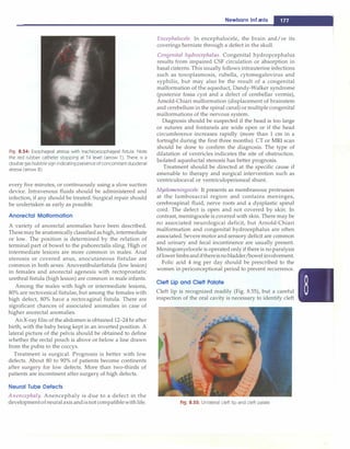-------------------------------N_e_w_b_o_r_n_i_n_fa_ n
_ts
......
-
Fig. 8.54: Esophageal atresia with tracheoesophageal fistula. Note
the red rubber catheter stopping at T4 level (arrow 1 ). There is a
double gas bubble sign indicating presence of concomitant duodenal
atresia (arrow 2)
every five minutes, or continuously using a slow suction
device. Intravenous fluids should be administered and
infection, if any should be treated. Surgical repair should
be undertaken as early as possible.
Anorectal Malformation
A variety of anorectal anomalies have been described.
These may be anatomically classified as high, intermediate
or low. The position is determined by the relation of
terminal part of bowel to the puborectalis sling. High or
intermediate lesions are more common in males. Anal
stenosis or covered anus, anocutaneous fistulae are
common in both sexes. Anovestibularfistula (low lesion)
in females and anorectal agenesis with rectoprostatic
urethral fistula (high lesion) are common in male infants.
Among the males with high or intermediate lesions,
80% are rectovesical fistulae, but among the females with
high defect, 80% have a rectovaginal fistula. There are
significant chances of associated anomalies in case of
higher anorectal anomalies.
An X-ray film of the abdomen is obtained 12-24 hr after
birth, with the baby being kept in an inverted position. A
lateral picture of the pelvis should be obtained to define
whether the rectal pouch is above or below a line drawn
from the pubis to the coccyx.
Treatment is surgical. Prognosis is better with low
defects. About 80 to 90% of patients become continents
after surgery for low defects. More than two-thirds of
patients are incontinent after surgery of high defects.
Neural Tube Defects
Anencephaly. Anencephaly is due to a defect in the
developmentof neural axis andisnot compatible with life.
Encephalocele. In encephalocele, the brain and/or its
coverings herniate through a defect in the skull.
Congenital hydrocephalus. Congenital hydropcephalus
results from impaired CSP circulation or absorption in
basal cisterns. This usually follows intrauterine infections
such as toxoplasmosis, rubella, cytomegalovirus and
syphilis, but may also be the result of a congenital
malformation of the aqueduct, Dandy-Walker syndrome
(posterior fossa cyst and a defect of cerebellar verrnis),
Arnold-Chiari malformation (displacement of brainstem
and cerebellum in the spinal canal) or multiple congenital
malformations of the nervous system.
Diagnosis should be suspected if the head is too large
or sutures and fontanels are wide open or if the head
circumference increases rapidly (more than 1 cm in a
fortnight during the first three months). CT or MRI scan
should be done to confirm the diagnosis. The type of
dilatation of ventricles indicates the site of obstruction.
Isolated aqueductal stenosis has better prognosis.
Treatment should be directed at the specific cause if
amenable to therapy and surgical intervention such as
ventriculocaval or ventriculoperioneal shunt.
Myelomeningocele. It presents as membranous protrusion
at the lumbosacral region and contains meninges,
cerebrospinal fluid, nerve roots and a dysplastic spinal
cord. The defect is open and not covered by skin. In
contrast, meningocele is covered with skin. There may be
no associated neurological deficit, but Arnold-Chiari
malformation and congenital hydrocephalus are often
associated. Severe motor and sensory deficit are common
and urinary and fecal incontinence are usually present.
Meningomyelocele is operated only ifthere is no paralysis
oflower limbsand ifthereis no bladder/bowel involvement.
Folic acid 4 mg per day should be prescribed to the
women in periconceptional period to prevent recurrence.
Cleft Lip and Cleft Palate
Cleft lip is recognized readily (Fig. 8.55), but a careful
inspection of the oral cavity is necessary to identify cleft
Fig. 8.55: Unilateral cleft lip and cleft palate
 