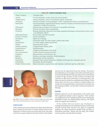 ___E
_
s
_
s
_
e
_
n
_
t
_
ia
_
l
_
P
_
e
_
d
_
i
_
a
_
tr
_
ic
_
s_________________________________
Drugs or chemical
Alcohol
Amphetamines
Androgens
Barbiturates
Chloroquine
Diazepam
Dicumarol
Diphenylhydantoin
Excessive smoking
Gentamicin
Heroin
Indomethacin
Iodides
Lithium carbonate
Propylthiouracil
Methotrexate
Oral contraceptives
Progestins
Quinine
Radiation
Tetracycline
Tolbutamide
Vitamin D (heavy dose)
Table 8.29: Common teratogenic drugs
Teratogenic effect
Growth retardation; cardiac, limb and facial anomalies
Learning disability, motor incoordination, hepatic calcification
Cleft lip and palate, tracheoesophageal fistula, congenital heart disease, masculinization
Cleft lip andpalate, congenital heart disease, induction of hepatic microsomal enzymes, respiratory
depression, withdrawal symptoms
Deafness after prolonged use, hemolysis in susceptible individuals
Cleft lip and palate, apnea, hypothermia
Bleeding, fetal death, depressed nasal bridge, stippling of phalanges, choanal atresia, cardiac, renal
and ophthalmic defects
Facial, cardiac and limb anomalies
Growth retardation
Eighth nerve damage
Intrauterine death, low birth weight, sudden infant death
Low birth weight, platelet dysfunction
Hypothyroidism, goiter
Congenital heart disease, goiter
Hypothyroidism
Congenital malformation, fetal death
Cardiac, limb and visceral anomalies
Masculinization, advanced bone age
Deafness, neurologic anomalies, thrombocytopenia
Microcephaly, mental retardation
Staining of teeth, enamel hypoplasia, inhibition of bone growth, congenital cataracts
Fetal death, thrombocytopenia
Mental retardation, supravalvular aortic stenosis, ventricular opacities, elfin facies
should not be separated from the mother. Exclusive
breastfeeding is encouraged. The infant should be given
isoniazidprophylaxis (5mg/kg/day)and is evaluatedat
6 weeks of age. If there is any evidence of tubercular
infection in the baby (clinically or radiologically), the
infant should be started on antitubercular therapy. If the
infant does not have any evidence of tuberculosis at 6
weeks, the isoniazid therapy continued for 6 months and
the infant given BCG vaccine after 2 weeks ofcessation of
therapy.
Syphilis
Fig. 8.59: Infant of diabetic mother. Note the large size of the baby
with broad shoulders and torso and a relatively smaller head
Syphilis infection can be transmitted to the infant who
have significant disease and its sequelae. If the mother
was diagnosed to have syphilis and she received adequate
treatment at least one month before delivery, the infant
does not require any treatment.
Tuberculosis
If the mother has active pulmonary tuberculosis that has
been treated for less than 2 months before birth or the
diagnosis of tuberculosis was made afterbirth, the baby
is at risk to acquire infection from the mother. Such babies
If the mother did not receive any treatment or
inadequate treatmentorher treatment status isnotknown
and the neonate does not have any signs of congenital
syphilis, the infant should be treated with procaine or
benzathine penicillin. Along with the baby, the mother
and her partner should also be treated.
 