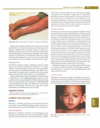Fig. 10.3: Diffuse erythematous rash seen in a patient with dengue
Examination should include nature of the rash and its
distribution, involvement of palms and soles (seen with
dengue, spotted fever, Kawasaki disease and Stevens­
Johnson syndrome), involvement of mucous membranes,
lymphadenopathy, organomegaly and signs of meningeal
irritation. Laboratory investigations that may assist
include complete blood counts, C-reactive protein, ESR,
blood culture, specific serologies and sometimes, biopsy.
Management
All efforts should be made to diagnose serious entities
earlier and institute immediate treatment. For stable
children, a specific diagnosis may not be always possible.
In this situation, symptomatic therapy, close observation,
explanation of danger signs to parents and staying away
from school until the rash resolves, is recommended.
Oftena childreceives drugs andantibiotics forfeverwhich
is followed by a rash. Distinguishing this rash as a viral
exanthem from drug related rash is difficult. Intense itching
is more commonly seen with a drug rash. Withholding the
drug, symptomatic therapy and observation is the usual
practice. Rechallenge with the same drug later under
observation is permitted ifthe rash was mild.
Suggested Reading
Sarkar R, Mishra K, Garg VK. Fever with rash in a child in India.
Indian J Dermatol Venereal Leprol 2012;78(3):251--62.
COMMON VIRAL INFECTIONS
Measles
Measles is a common and serious exanthematous illness,
which still causes 350,000 childhood deaths annually in
developing countries of which 80,000 occur in India alone.
Etiopathogenesis
Measles is caused by an RNA virus belonging to the
Paramyxovirus family. The virus is transmitted by droplet
spread from the secretions of the nose and throat, usually
Infections and Infestations -
4 days before to 5 days after the rash. The disease is highly
contagious with secondary attack rates in susceptible
household contacts exceeding 90%. The portal of entry is
the respiratory tract where the virus multiplies in the
respiratory epithelium. Primary viremia occurs resulting
in infection of the reticuloendothelial system, followed by
secondary viremia, which results in systemic symptoms.
The incubation period is around 10 days.
Clinical Features
The disease is most common in preschool children; infants
are protected bytransplacentalantibodies,which generally
decay by 9 months (hence the rationale for vaccination at
this age). The prodromal phase is characterized by fever,
rhinorrhea, conjunctiva! congestion and a dry hacking
cough. Koplik spots, considered as pathognomonic of
measles, appear opposite the lower second molars on the
buccal mucosa on the second or third day of the illness as
gray or white lesions resembling grains of sand with
surrounding erythema. The rash, usually apparent on the
fourth day with rise in fever, appears as faint reddish
macules behind the ears, along the hairline and on the
posterior aspects of the cheeks (Fig. 10.4). Therash rapidly
becomes maculopapular and spreads to the face, the neck,
chest, arms, trunk, thighs and legs in that order over the
next 2-3 days. It then starts fading in the same order that it
appeared and leaves behind branny desquamation and
brownish discoloration, which fade over 10 days.
Modified measles, seen in partially immune individuals,
is a milder and shorter illness. Hemorrhagic measles is
characterized by a purpuric rash and bleeding from the
nose, mouth or bowel.
Complications
Widespread mucosal damage and significant immuno­
suppression induced by measles account for the frequent
complications seen with this viralinfection. Complications
are more frequent in the very young, malnourished and the
Fig. 10.4: Conjunctiva! congestion and morbilliform rash in a child
with measles
 