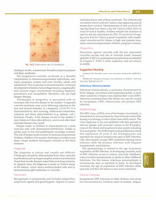 Fig. 10.5: Polymorphic rash of chickenpox
leading to stroke, autoimmune thrombocytopenic purpura
and Reye syndrome.
The progressive varicella syndrome is a dreaded
complication in immunocompromised individuals, neo­
nates, pregnant women and even healthy adults and
adolescents. This syndrome is characterized by continued
development oflesions, hemorrhagiclesions,coagulopathy
and visceral organ involvement including hepatitis,
pneumonia and encephalitis. Mortality rate are high
despite therapy.
Chickenpox in pregnancy is associated with an
increased risk of severe disease in the mother. Congenital
varicella syndrome may occur following infection in the
first and second trimester at a frequency of 0.4-2%. It is
characterized by skin scarring, malformed extremities,
cataracts and brain abnormalities (e.g. aplasia, calci­
fications). Finally, if the disease occurs in the mother 5
days before to 2 days after delivery, severe and often fatal
neonatal disease may result.
Herpes zoster in children is characterized by a mild
vesicular rash with dermatomal distribution. Unlike in
adults, pain is less and postherpetic neuralgia unusual.
The risk of herpes zosteris more in immunocompromised
children, children who acquire chickenpox in infancy and
those whose mothers developed varicella in the third
trimester.
Diagnosis
The diagnosis is clinical and usually not difficult.
Chickenpox should be differentiated from other vesicular
exanthematasuch asherpes simplex, enteroviral infections
(hand-foot-mouth disease), insect bites and drug reactions.
In atypical cases, the diagnosis is made on Tzanck smear
of the lesions, which shows multinucleated cells and by
demonstrating IgM antibodies to varicella.
Treatment
Management is symptomatic and includes antipyretics,
antipruritic agents and good hygiene. Aspirin is contra-
Infections and Infestations -
indicated due to risk of Reye syndrome. The child should
not attend school until new lesions stop appearing and all
lesions have crusted. Administration of oral acyclovir (20
mg/kg/dose four times a day for 5 days) within 24 hr of
onset of rash in healthy children reduces the duration of
rash by one day and lesions by 25%. IV acyclovir (10 mg/
kg every 8 hr for 7 days) is given to patients with compli­
cated varicella and for illness in high risk patients (neo­
nates, immunocompromised children, pregnant women).
Prevention
Prevention against varicella with the live attenuated
varicella vaccine and use of varicella zoster immune
globulin (YZIG)forpostexposure prophylaxisaredetailed
in Chapter 9. YZIG is fairly expensive and not always
available.
Suggested Reading
Gershon AA: Varicella-zoster virus infections. Pediatr Rev 2008;29(1):
5-10
Whitley RJ. Therapy ofherpes virus infections in children. Adv Exp
Med Biol 2008;609:216-32
Infectious Mononucleosis
Infectious mononucleosis, a syndrome characterized by
fever, fatigue, sore throat and lymphadenopathy, is most
often caused by a herpes virus, Epstein-Barr virus (EBY).
Infectious mononucleosis-like illness can also be caused
by toxoplasma, CMY, adenoviruses and primary HIV
infection.
Epidemiology
The EBY virus, a DNA virus of the herpes virus family, is
transmitted in oral secretions by closeintimatecontactlike
kissing or exchange of saliva from close child contact. The
virus replicates in the oral epithelial cells then spreads to
salivary glands with eventual viremia to the B lympho­
cytes in the blood and lymphoreticular system including
liver andspleen. The CDS lymphocytes proliferate to check
this replication of virus in the B lymphocytes and
represent the atypical lymphocytes seen in EBY infection.
Like other herpes viruses, EBY establishes lifelong latent
infection after the primary infection with frequent
asymptomatic reactivations.
The epidemiology is related to the age of primary
acquisition of EBYinfection. In developing countries, most
of EBY infection occurs in infancy and early childhood,
whenitiseitherasymptomatic orsimilar tootherchildhood
infections. For this reason, infectious mononucleosis is
uncommonly seen or reported in India. In developed
countries, the age of acquisition of EBY infection shifts
upwards and thus the illness is seen more commonly.
Clinical Features
Symptomatic EBY infections in older children and adults
are characterized by insidious onset of malaise, fatigue,
 