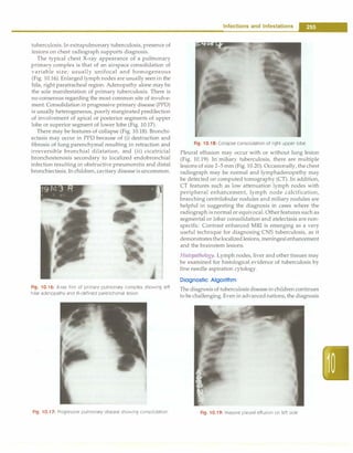 tuberculosis. In extrapulmonary tuberculosis, presence of
lesions on chest radiograph supports diagnosis.
The typical chest X-ray appearance of a pulmonary
primary complex is that of an airspace consolidation of
variable size, usually unifocal and homogeneous
(Fig. 10.16). Enlarged lymph nodes are usually seen in the
hila, right paratracheal region. Adenopathy alone may be
the sole manifestation of primary tuberculosis. There is
no consensus regarding the most common site of involve­
ment. Consolidation in progressive primary disease (PPD)
is usually heterogeneous, poorly marginated predilection
of involvement of apical or posterior segments of upper
lobe or superior segment of lower lobe (Fig. 10.17).
There may be features of collapse (Fig. 10.18). Bronchi­
ectasis may occur in PPD because of (i) destruction and
fibrosis of lung parenchymal resulting in retraction and
irreversible bronchial dilatation, and (ii) cicatricial
bronchostenosis secondary to localized endobronchial
infection resulting in obstructive pneumonitis and distal
bronchiectasis. In children, cavitary disease isuncommon.
Fig. 10.16: X-ray film of primary pulmonary complex showing left
hilar adenopathy and ill-defined parenchymal lesion
Fig. 10.17: Progressive pulmonary disease showing consolidation
Infections and Infestations -
Fig. 10.18: Collapse consolidation of right upper lobe
Pleural effusion may occur with or without lung lesion
(Fig. 10.19). In miliary tuberculosis, there are multiple
lesions of size 2-5 mm (Fig. 10.20). Occasionally, the chest
radiograph may be normal and lymphadenopathy may
be detected on computed tomography (CT). In addition,
CT features such as low attenuation lymph nodes with
peripheral enhancement, lymph node calcification,
branching centrilobular nodules and miliary nodules are
helpful in suggesting the diagnosis in cases where the
radiograph is normal or equivocal. Other features such as
segmental or lobar consolidation and atelectasis are non­
specific. Contrast enhanced MRI is emerging as a very
useful technique for diagnosing CNS tuberculosis, as it
demonstratesthelocalizedlesions, meningealenhancement
and the brainstem lesions.
Histopathology. Lymph nodes, liver and other tissues may
be examined for histological evidence of tuberculosis by
fine needle aspiration cytology.
Diagnostic Algorithm
The diagnosis of tuberculosis diseasein children continues
to be challenging. Even in advanced nations, the diagnosis
Fig. 10.19: Massive pleural effusion on left side
 