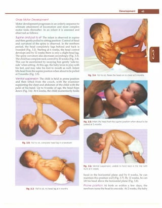 --------------------------------------D_e_v_e_io_p_m_e_n_t.....
-
Gross Motor Development
Motor development progresses in an orderly sequence to
ultimate attainment of locomotion and more complex
motor tasks thereafter. In an infant it is assessed and
observed as follows:
Supine and pull to sit The infant is observed in supine
and then gently pulled to sitting position. Control of head
and curvature of the spine is observed. In the newborn
period, the head completely lags behind and back is
rounded (Fig. 3.2). Starting at 6 weeks, the head control
develops and by 12 weeks there is only a slight head lag.
The spine curvature also decreases accordingly (Fig. 3.3).
The child has completeneck control by20 weeks (Fig. 3.4).
This can be ascertained by swaying him gently 'side-to­
side' whensitting. At this age, the baby loves to play with
his feet, and may take his foot to mouth as well. Infant
lifts head from the supinepositionwhen about to bepulled
at 5 months (Fig. 3.5).
Ventral suspension The child is held in prone position
and then lifted from the couch, with the examiner
supporting the chest and abdomen of the child with the
palm of his hand. Up to 4 weeks of age, the head flops
down (Fig. 3.6). At 6 weeks, the child momentarily holds
Fig. 3.12: Pull to sit; complete head lag in a newborn
Fig. 3.3: Pull to sit; no head lag at 4 months
Fig. 3.4: Pull to sit; flexes the head on to chest at 5 months
Fig. 3.5: Infant lifts head from the supine position when about to be
pulled at 5 months
Fig. 3.6: Ventral suspension; unable to hold neck in the line with
trunk at 4 weeks
head in the horizontal plane and by 8 weeks, he can
maintain this position well (Fig. 3.7). By 12 weeks, he can
lift his head above the horizontal plane (Fig. 3.8).
Prone position At birth or within a few days, the
newborn turns the head to one side. At 2 weeks, the baby
 