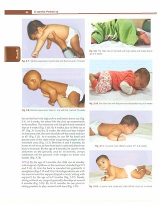 --E-ss_e_n_t_i_a,_P_e _d_ia_t_r_ic·
s----------------------------------
Fig. 3.7: Ventral suspension; head in line with the trunk at 8-10 weeks
Fig. 3.8: Ventral suspension; head in line with the trunk at 12 weeks
lies on the bed with high pelvis and knees drawn up (Fig.
3.9). At 4 weeks, the infant lifts the chin up momentarily
in the midline. The infantlies with flat pelvis and extended
hips at 6 weeks (Fig. 3.10). By 8 weeks, face is lifted up at
45°
(Fig. 3.11) and by 12 weeks, the child can bear weight
on forearms with chin and shoulder off the couch and face
at 45°
(Fig. 3.12). At 6 months, he can lift his head and
greater part of the chest while supporting weight on the
extended arms (Fig. 3.13). Between 4 and 6 months, he
learns to roll over, at first from back to side and thenfrom
back to stomach. By the age of 8 months, he crawls (with
abdomen on the ground) and by 10 months, creeps
(abdomen off the ground, with weight on knees and
hands) (Fig. 3.14).
Sitting By the age of 5 months, the child can sit steadily
with support of pillows or the examiner's hands (Figs 3.15
and 3.16). At first the back is rounded but gradually it
straightens (Figs3.15 and3.16). He independently sitswith
his arms forward for support (tripod or truly 'sitting with
support') by the age of 6-7 months (Fig. 3.17). Steady
sitting without any support generally develops at around
8 months (Fig. 3.18). By 10-11 months, he can pivot in
sitting position to play around with toys (Fig. 3.19).
Fig. 3.9: The infant lies on the bed with high pelvis and knees drawn
up at 2 weeks
Fig. 3.10: The infant lies with flat pelvis and extended hips at 6 weeks
Fig. 3.11: In prone: face lifted to about 45°
at 8 weeks
Fig. 3.12: In prone: face, head and chest off the couch at 3 months
 
