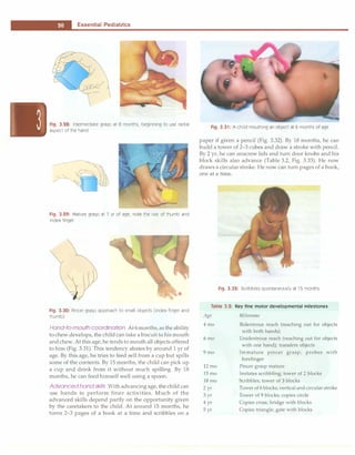 -
L..:
E
::
s:s:e
:,:
n
::,:
t
::,:
ia
:,:
l
_;
P
:.;
e:d:i:a:tr�ic
:;
s
:_________________________________
Fig. 3.28: Intermediate grasp at 8 months, beginning to use radial
aspect of the hand
Fig. 3.29: Mature grasp at 1 yr of age, note the use of thumb and
index finger
Fig. 3.30: Pincer grasp approach to small objects (index finger and
thumb)
Hand-to-mouth coordination At 6months,as theability
to chew develops, the child can take a biscuit to his mouth
andchew. At this age, he tends to mouth all objects offered
to him (Fig. 3.31). This tendency abates by around 1 yr of
age. By this age, he tries to feed self from a cup but spills
some of the contents. By 15 months, the child can pick up
a cup and drink from it without much spilling. By 18
months, he can feed himself well using a spoon.
Advanced hand skills With advancing age, the child can
use hands to perform finer activities. Much of the
advanced skills depend partly on the opportunity given
by the caretakers to the child. At around 15 months, he
turns 2-3 pages of a book at a time and scribbles on a
Fig. 3.31: A child mouthing an object at 6 months of age
paper if given a pencil (Fig. 3.32). By 18 mont�s, he c�n
build a tower of 2-3 cubes and draw a stroke with pencil.
By 2 yr, he can unscrew lids and turn door knobs and his
block skills also advance (Table 3.2, Fig. 3.33). He now
draws a circular stroke. He now can turn pages of a book,
one at a time.
Fig. 3.32: Scribbles spontaneously at 15 months
Table 3.2: Key fine motor developmental milestones
Age
4mo
6mo
9mo
12mo
15mo
18 mo
2yr
3 yr
4yr
5yr
Milestone
Bidextrous reach (reaching out for objects
with both hands)
Unidextrous reach (reaching out for objects
with one hand); transfers objects
Immature pincer grasp; probes with
forefinger
Pincer grasp mature
Imitates scribbling; tower of 2blocks
Scribbles; tower of 3 blocks
Tower of 6 blocks; vertical and circular stroke
Tower of 9blocks; copies circle
Copies cross; bridge with blocks
Copies triangle; gate with blocks
 
