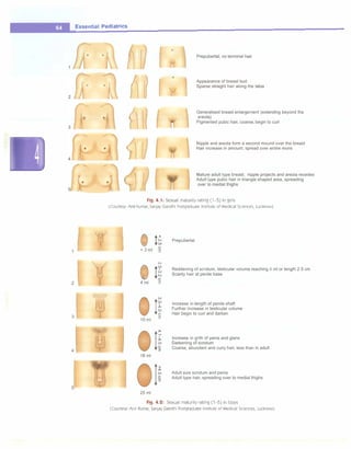 ___E_ss_e_
n_t_
ia_
i_P_
e _
d_ia_
t _
r_
ic_
s__________________________________
2
/
3 �
4
5
Prepubertal; no terminal hair
Appearance of breast bud
Sparse straight hair along the labia
Generalised breast enlargement (extending beyond the
areola)
Pigmented pubic hair, coarse, begin to curl
Nipple and areola form a second mound over the breast
Hair increase in amount, spread over entire mons
Mature adult type breast; nipple projects and areola recedes
Adult type pubic hair in triangle shaped area, spreading
over to medial thighs
Fig. 4.1: Sexual maturity rating (1-5) in girls
(Courtesy, Anil Kumar, Sanjay Gandhi Postgraduate Institute of Medical Sciences, Lucknow)
J 0 t�
< 3 ml
0 !�
4ml 3
11
10 ml
3
Ii
16ml
It
25 ml
Prepubertal
Reddening of scrotum, testicular volume reaching 4 ml or length 2.5 cm
Scanty hair at penile base
Increase in length of penile shaft
Further increase in testicular volume
Hair begin to curl and darken
Increase in girth of penis and glans
Darkening of scrotum
Coarse, abundant and curly hair, less than in adult
Adult size scrotum and penis
Adult type hair, spreading over to medial thighs
Fig. 4.2: Sexual maturity rating (1-5) in boys
(Courtesy: Anil Kumar, Sanjay Gandhi Postgraduate Institute of Medical Sciences, Lucknow)
 