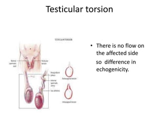 Paediatric scrotum Slide 11