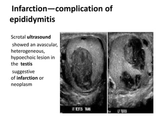 Paediatric scrotum Slide 29