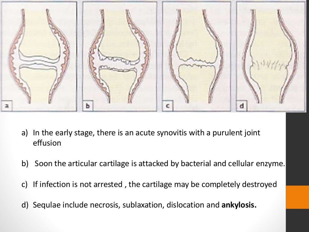 Paediatric Septic Arthritis
