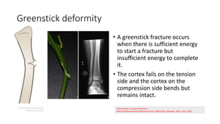 Greenstick deformity
• A greenstick fracture occurs
when there is sufficient energy
to start a fracture but
insufficient energy to complete
it.
• The cortex fails on the tension
side and the cortex on the
compression side bends but
remains intact.
https://www.rch.org.au/fracture-
education/biomechanics/Biomechanical_differences_between_adult_and_child/
 
