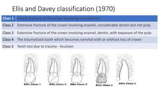 Paedo Lecture - Trauma to Anterior Teeth in Children.pdf