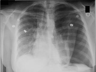 Paeds chest x ray | PPT
